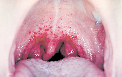 التهاب الحلق واللوزتين بالمكروب السبحى الاصابه بالحمى الروماتزميه