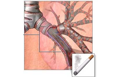 التهاب القصبات والتدخين أسباب السعال الشهيرة