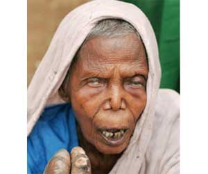 الجذام مرض خطير مميت تتساقط بسببه الأعضاء ويتشوه الوجه