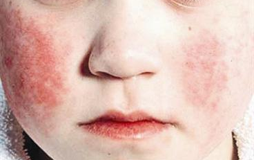 وجه الطفل المصاب بالحمى القرمزية