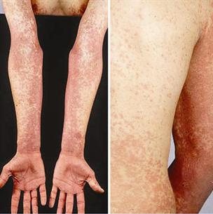 الطفح الجلدي من أعراض الحمى القرمزية