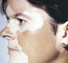 البهاق مرض غير خطير يؤدي إلى ظهور بقع بيضاء في الجسم