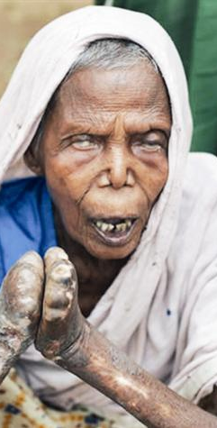 الجذام مرض خطير قاتل تتساقط بسببه الأعضاء ويدمر الوجه