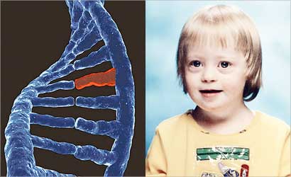 طفل منغولي بسبب اختلال في عدد الكروموسومات  و طفرة الجينات والإصابة بالأمراض الوراثية