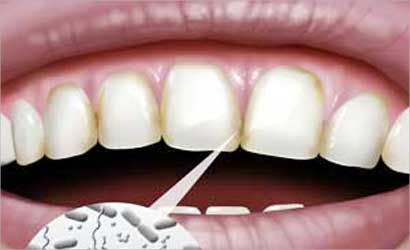 u0627u0644u0631u0627u0626u062du0629 u0627u0644u0643u0631u064au0647u0629 u062au0646u062cu0645 u0639u0646 u062au062du0644u0644 u0627u0644u0628u0643u062au064au0631u064au0627 u062fu0627u062eu0644 u0627u0644u0641u0645 u0648u0627u0644u0623u0633u0646u0627u0646