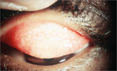 الرمد الربيعي ينتشر بشدة هذه الأيام