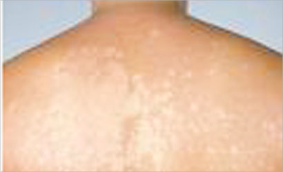 u062du0631u0648u0642 u0627u0644u0634u0645u0633 u0627u0644u062du0627u062fu0629 u0628u0633u0628u0628 u0627u0644u0623u0634u0639u0629 u0627u0644u0645u062au0648u0647u062cu0629