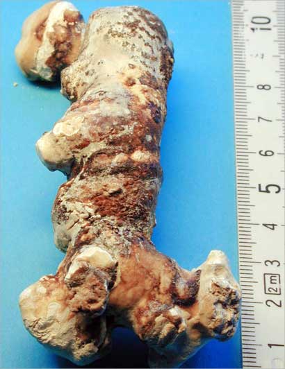 المغص الكلوي بفعل حصوات الكلى يسبب تركيز البول نتيجة التعرق الغزير