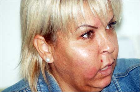 صفاء بعد زيارتها الطبيب لنفخ شفاهها... فنفخ وجهها (تصوير اسعد عبدالله)