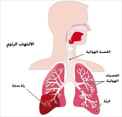النزلات الشعبية والالتهابات الرئوية تكثر الإصابة بها هذه الأيام  