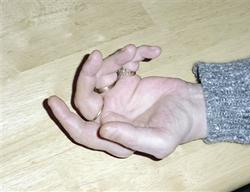 تورم الاصابع بسبب تقلص الاوعية الدموية