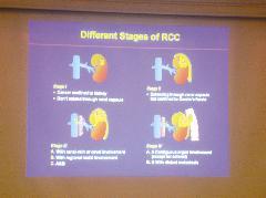رسم بياني يوضح مراحل تطور سرطان الكلى