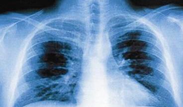 معظم وفيات وباء الأنفلونزا بسبب الالتهاب الرئوي