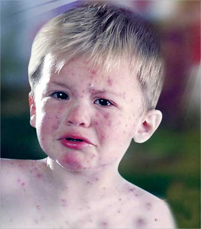 الجديري المائي مرض سريع الانتشار ويأتي بصورة وبائية 