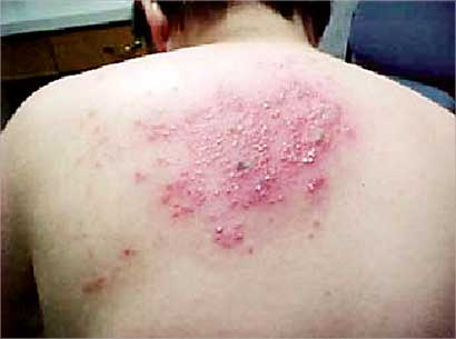 الهربس العصبي «العصب الناري» يسبب آلاماً شديدة وحروقات بالجلد 