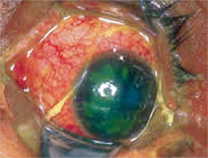 قرح والتهابات العين بسبب ?يروس الهربس العصبي 