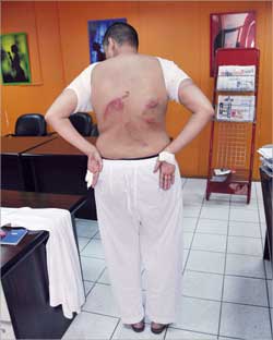 آثار الضرب بادية على ظهر (م)