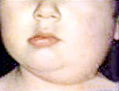 النكاف مرض يشوه جمال الربيع 