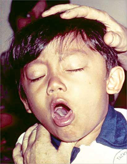 السعال الديكي أخطر أمراض الربيع 