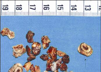 البعض يعاني من الصداع مع بداية الصوم