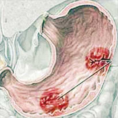 الصوم يضر بمرضى قرحة المعدة الحادة