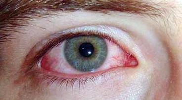 الحكة الشديدة واحمرار العين من أعراض الحساسية الموسمية