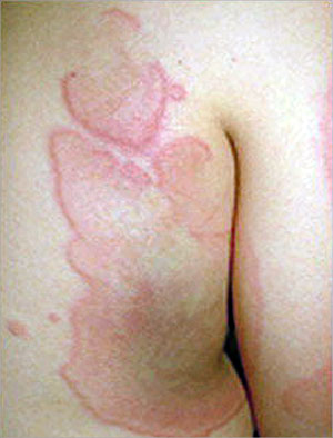 حساسية الجلد طفح جلدي ارتكاريا