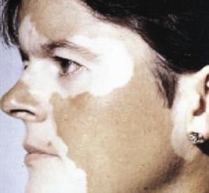 ليس المقصود بالأبرص المصاب بالبهاق