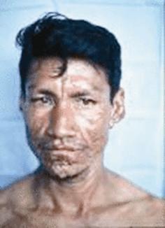 الجذام مرض خطير قاتل تتساقط بسببه الأعضاء ويدمر الوجه