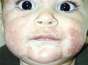 حساسية الجلد تصيب الأطفال في هيئة اكزيما