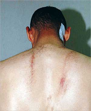 اثار الضرب بالحزام بادية على ظهر أيمن