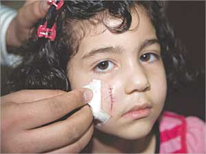 الجرح باد في وجه الطفلة ديما (تصوير نور هنداوي)