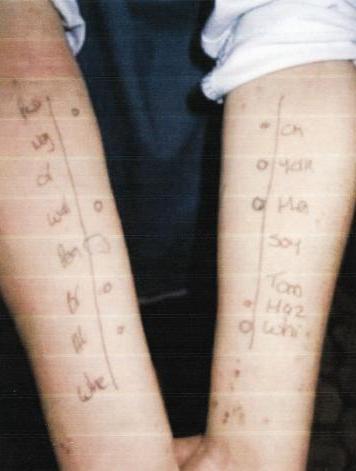 فحص الحساسية لمعرفة سبب الربو