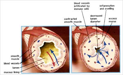 شكلان للرئة قبل وبعد الإصابة بالربو
