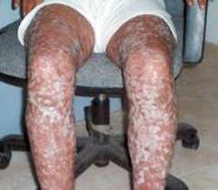 u0644u0627 u064au0648u062cu062f u0639u0644u0627u062c u0634u0627u0641u064d u0644u0644u0635u062fu0641u064au0629 u0644u0644u0622u0646