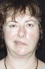 شلل الوجه ينتشر هذه الأيام بفعل تيارات الهواء الباردة