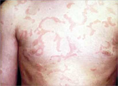 جفاف البشرة بفعل مناخ البرد 