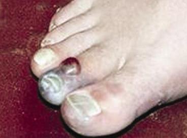 عضة الصقيع بسبب طقس الشتاء