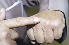 الصدفية انتشرت بين سكان «أم الهيمان»