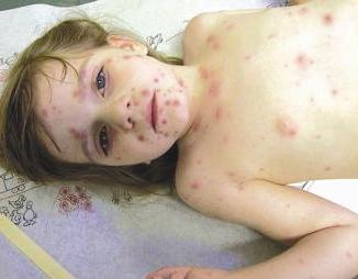 الجديري المائي سريع الانتشار بصورة وبائية