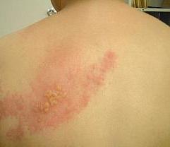 الهربس العصبي «الحزام الناري» يسبب آلاماً شديدة وحرقاناً بالجلد