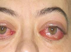 قرح والتهابات العين بسبب فيروس الهربس العصبي