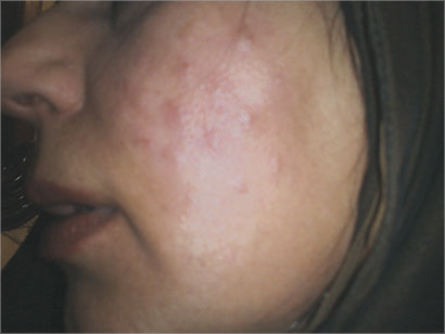 التشويه طال الخد الايسر 