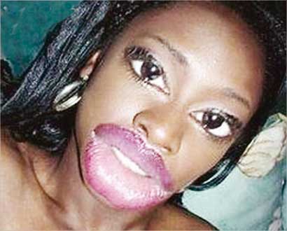 شفتان منفوختان