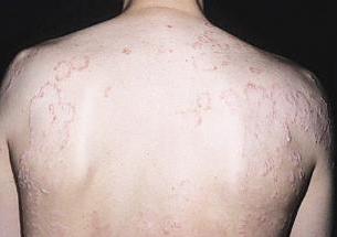 حساسية الجلد طفح جلدي وحكة شديدة