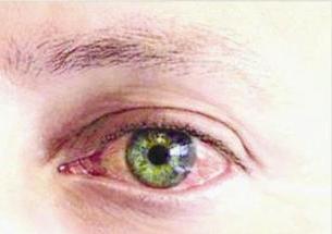 حساسية العين ... الشعور بحكة واحتقان العين