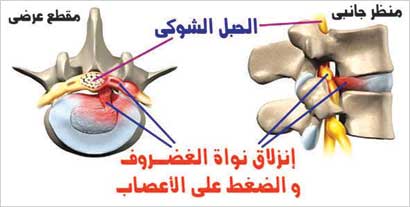 حمل أشياء ثقيلة يؤدي إلى تمزق أربطة فقرات الظهر 