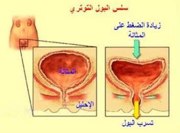 سلس البول لا تفصح عنه النساء