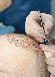 جانب من اجراء عملية زرع الشعر