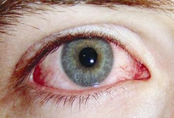 الرمد الربيعي ... أمراض موسمية تصيب الملتحمة